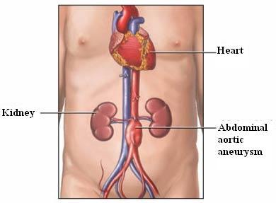 Abdominal Aortic Aneurysm